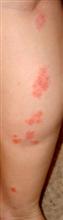 Psoriasis on leg before